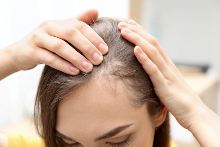 Woman parting thinning hair near scalp, showing early signs of hair loss before considering PRP for hair loss treatment