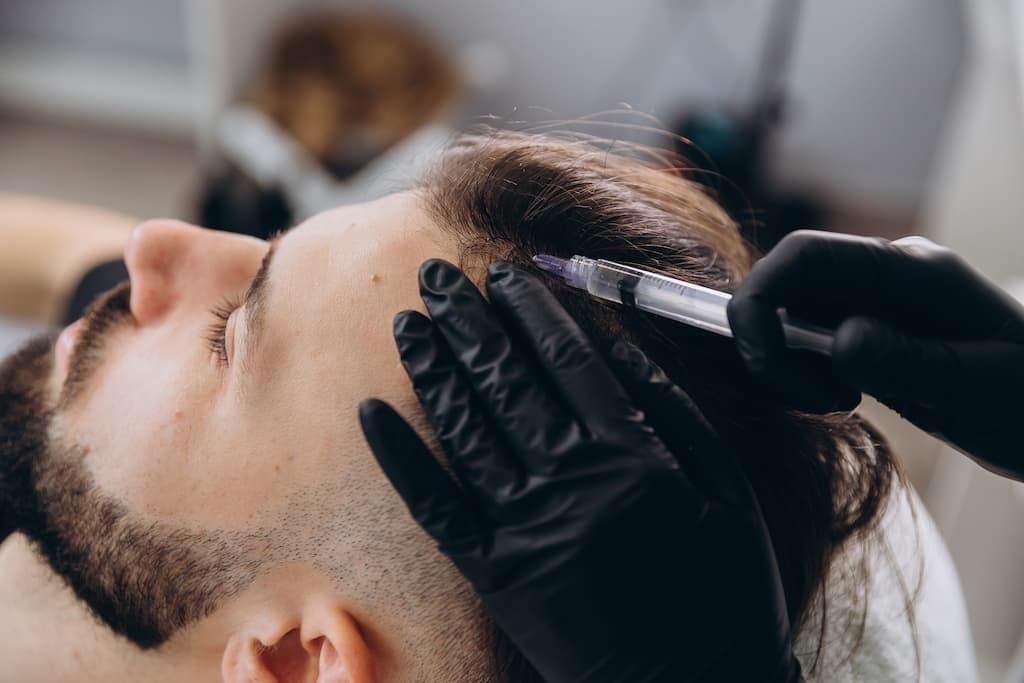 Man receiving PRP hair restoration injection in scalp by practitioner in black gloves, demonstrating platelet-rich plasma therapy procedure for natural hair regrowth stimulation