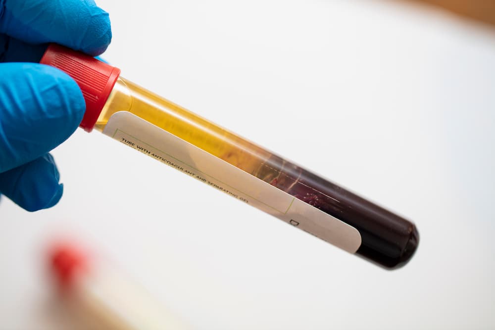 Gloved hand holding a centrifuge‑processed blood tube illustrating the difference between PRP (Platelet‑Rich Plasma) and PRF (Platelet‑Rich Fibrin) therapies.